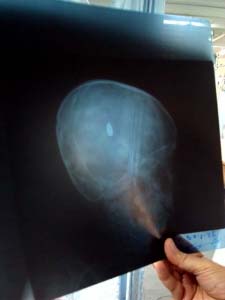Serpihan peluru tertanam di otak Ahmad Hassanin