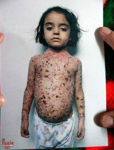 reej, salah seorang anak Gaza yang terkena kesan langsung bom fosfor putih. (Foto: SA)
